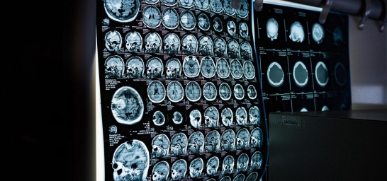 Plano de saúde deve pagar PET-CT para tumor neuroendócrino