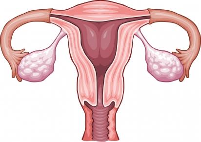 Niraparibe Zejula câncer de ovário