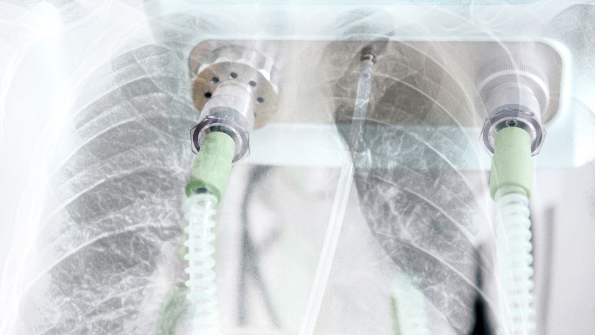 Como funciona a ECMO e quando a terapia &eacute; indicada