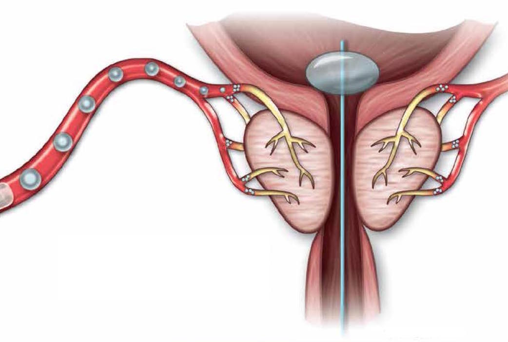 Embolização das artérias da próstata - Plano de saúde deve custear cirurgia fora do rol da ANS