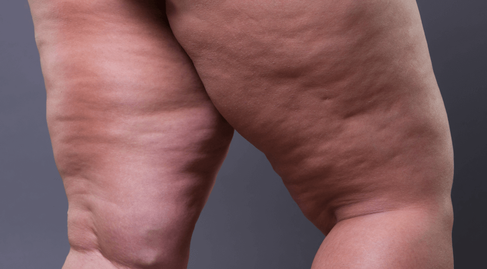lipoaspiração para lipedema pelo plano de saúde