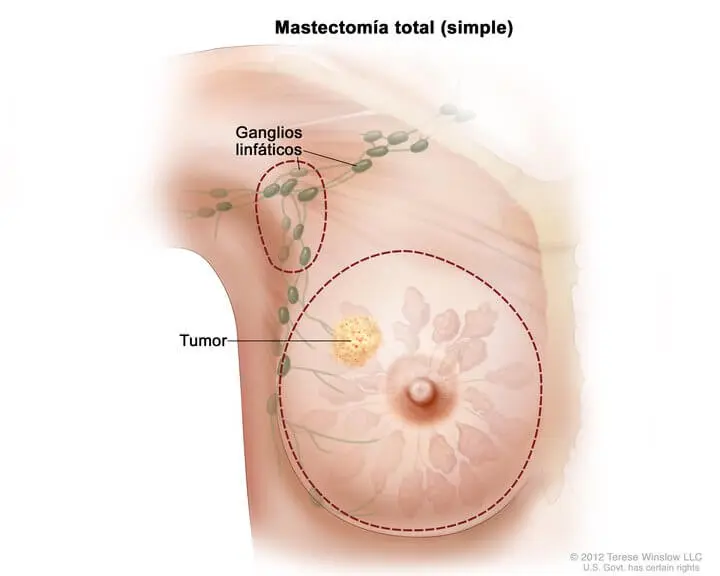 Mastectomia preventiva para câncer de mama